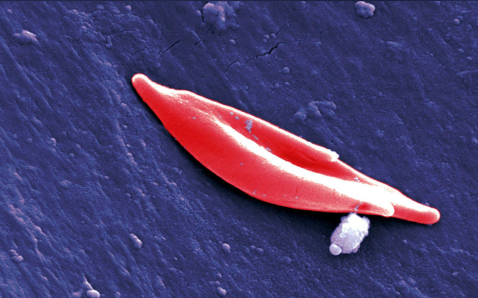 Image of sickle cell