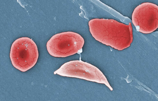 FDA approves two sickle cell therapies, including first CRISPR medicine